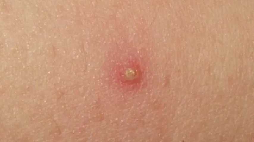 Lesión provocada por la foliculitis. (Foto: Wikimedia)